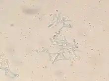 Swartz Lamkins stain of skin biopsy