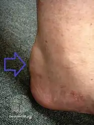 Cholesterol build up within the Achilles tendon[8]