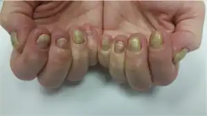 Yellow nail syndrome