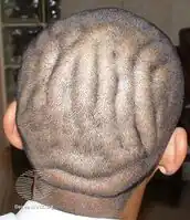 Cutis verticis gyrata