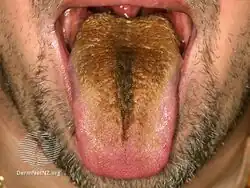 Black hairy tongue
