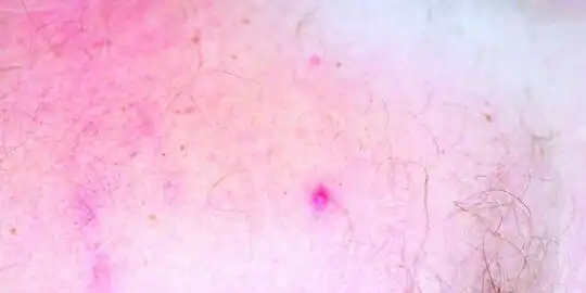 Closer view papulovesicular lesions on individual with rickettsialpox.