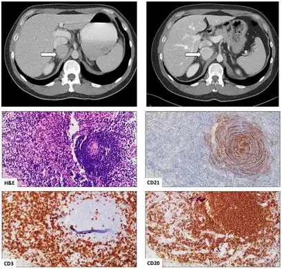Female was found to have a mass in the retroperitoneal space deep to the inferior vena cava on CT scan; mass was biopsied and demonstrated the HV variant of UCD(CT scans at presentation and 6-year follow up)[5]