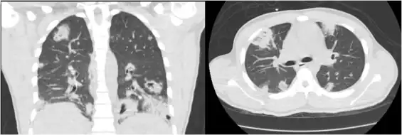 CT chest shows multifocal cavitary lung lesions[5]