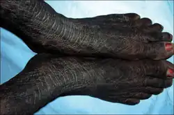 AN in ovarian cancer