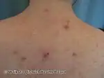 Acne uticata