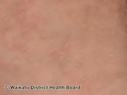 Acrokeratosis verruciformis of Hopf