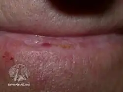 Actinic cheilitis