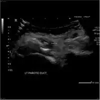 Acute left parotid sialadenitis