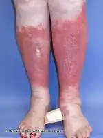 Lipodermatosclerosis (red plaques)