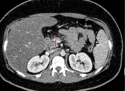 Acute on chronic pancreatitis