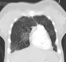 Acute pulmonary edema on CT
