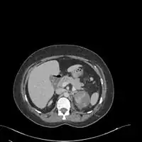 Acute pyelonephritis (with renal vein thrombosis)