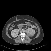 Acute pyelonephritis {with renal vein thrombosis)