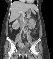 Acute pyelonephritis (with renal vein thrombosis)