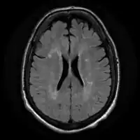 Acute severe hepatic encephalopathy