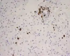 Aggressive multiple sclerosis