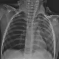 Foreign body aspiration with bronchoscopy finding a nut in the right bronchus. Note right lung (left of image) is hyperinflated (darker).[33]