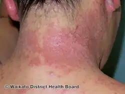 Contact allergic dermatitis