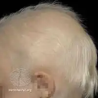 Anhidrotic ectodermal dysplasia