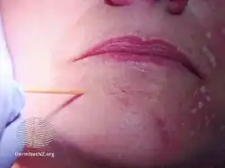 Applying trichloracetic acid for TCA CROSS procedures