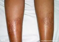 Asteatotic dermatitis