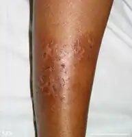 Asteatotic dermatitis