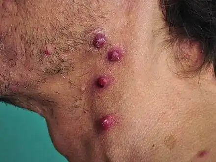 Characteristic tumor-like skin lesions