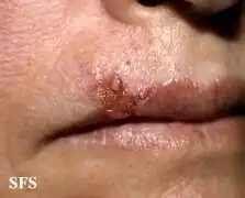 Basal-cell carcinoma