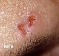 Basal-cell carcinoma
