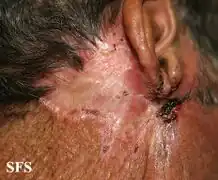 Basal-cell carcinoma
