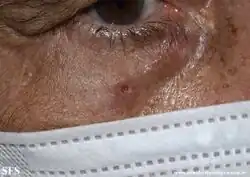 Basaloid Follicular Hamartoma