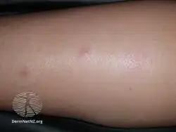 Bedbug bites