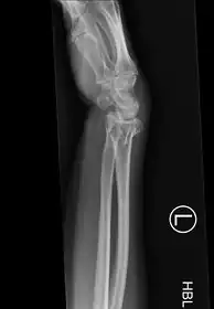 Bilateral Colles fractures/lateral
