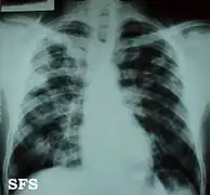 Chest X-ray