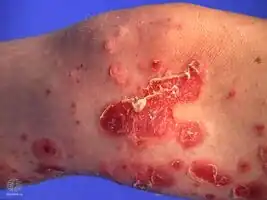 Bullous impetigo