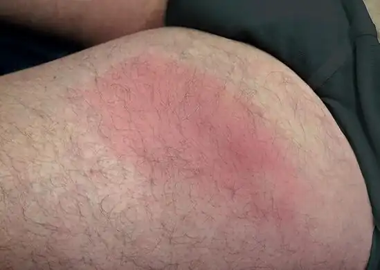 Classical presentation- migratory panniculitis