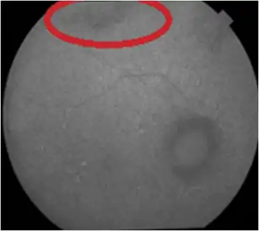 Hyperautofluorescence and hypoautofluorescence granular patterns in posterior pole[12]