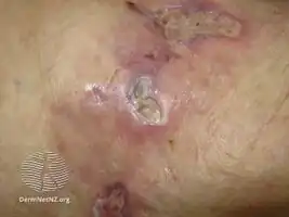 Calciphylaxis