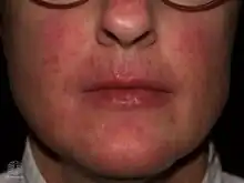 Candida albicans folliculitis