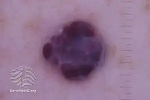 Cavernous haemangioma, nonpolarised dermoscopy view