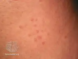 Cholinergic urticaria