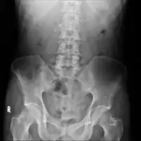 Chronic calcific pancreatitis