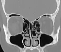 Bilateral concha bullosa, larger on the left