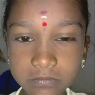 Saddle nose in congenital syphilis