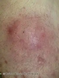 Aspergillosis of skin