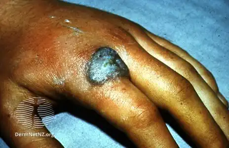 Skin tuberculosis on hand