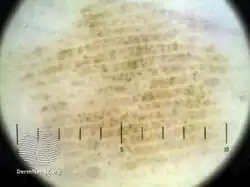 Parallel ridge pattern