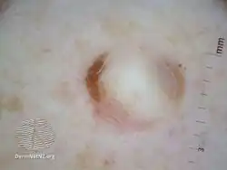 Desmoplastic melanoma