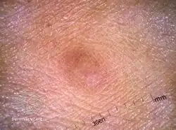 Desmoplastic melanoma